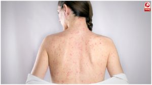Rubella Syndrome