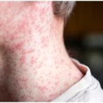 Rubella Syndrome