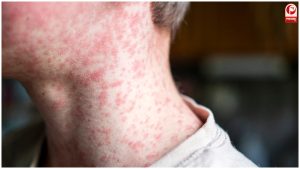 Rubella Syndrome