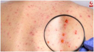 Rubella Syndrome